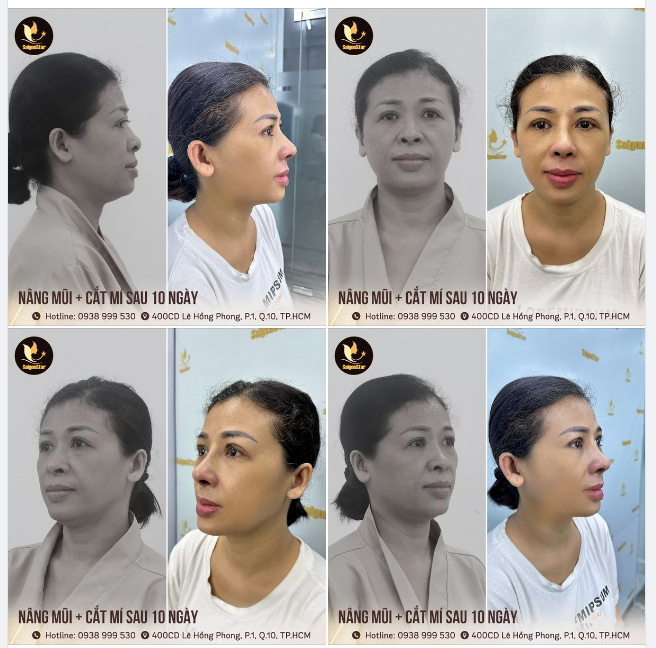 COMBO NÂNG MŨI CẮT MÍ – ĐẸP TOÀN DIỆN CHỈ SAU 10 NGÀY.