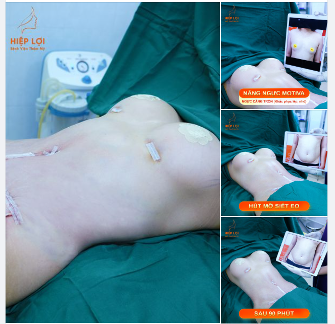 COMBO CA NGỰC - HÚT MỠ SIẾT EO CHẤT LƯỢNG TẠI HIỆP LỢI