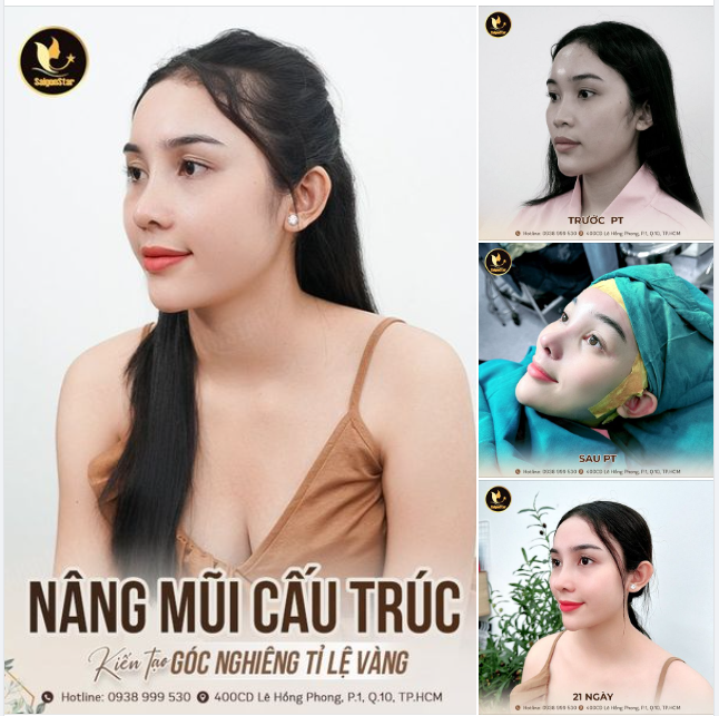 GEN Z TRỐN PHỤ HUYNH ĐI NÂNG MŨI VÀ CÁI KẾT