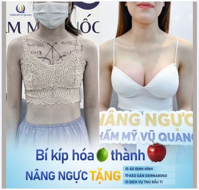 Hè đã về, mùa của những bộ bikini đã đến! Chị em ngực lép, ngực xệ bơi hết vào đây để bác sĩ tân trang lại V1 giúp tự tin thả dáng nào.