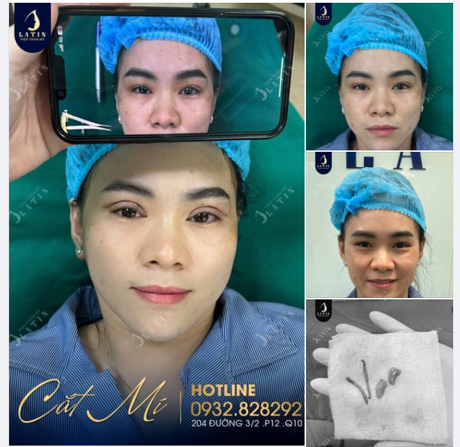 Chị khách yêu cầu mí to tròn như Ngọc Trinh