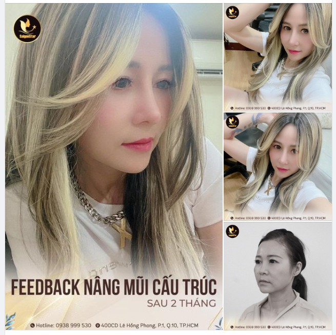 Chiếc Feedback siêu uy tín sau 2 tháng nâng mũi.