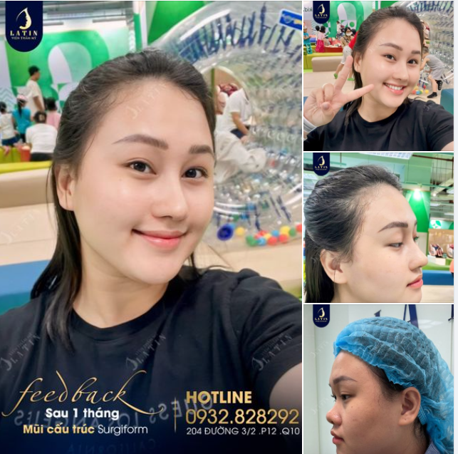  Feedback mũi cấu trúc  surgiform 1 tháng tuổi lên dáng sắc nét cho em gái.