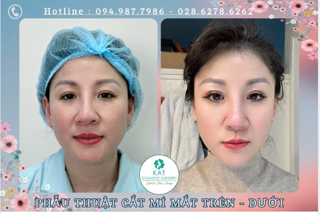 Chị khách yêu 10 năm trước phẫu thuật bấm mí tại KAT, sau 10 năm chị lại bay về từ Mỹ để làm phẫu thuật cắt mí mắt trên dưới .