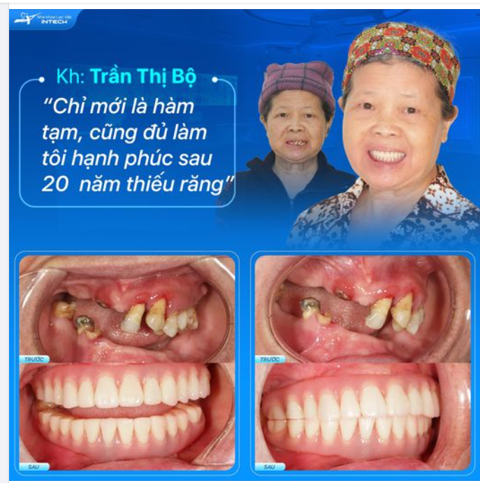 DÙ MỚI CHỈ LẮP HÀM RĂNG TẠM, ĐÃ ĐỦ LÀM NGƯỜI PHỤ NỮ THIẾU RĂNG 20 NĂM THẤY HẠNH PHÚC