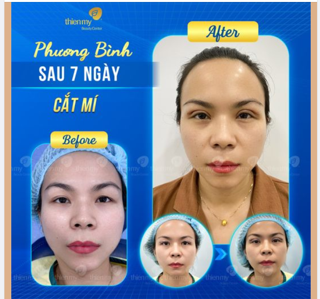 THÀNH QUẢ SAU 7 NGÀY CẮT MÍ TẠI THIỆN MỸ