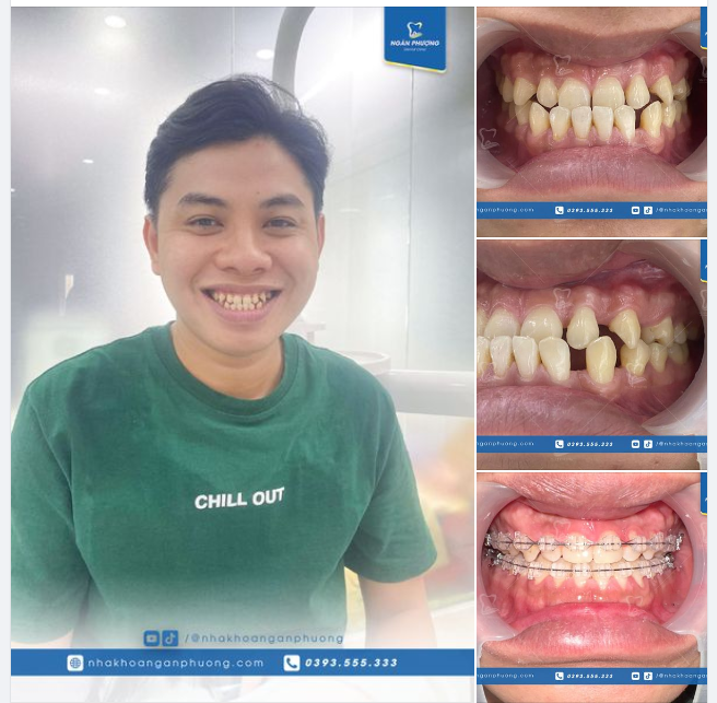 Răng thưa, khớp cắn ngược thay đổi 180 độ chỉ sau hơn 1 năm
