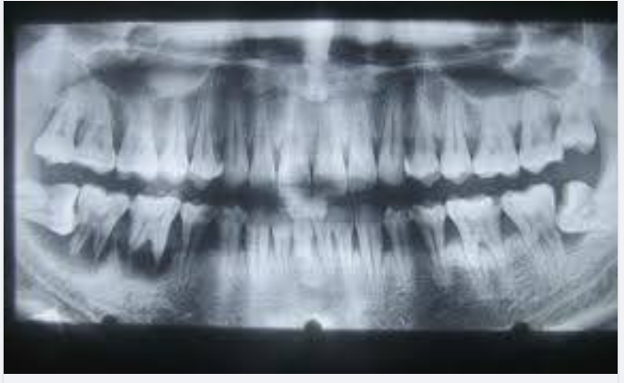 DẤU HIỆU CẦN PHẢI NHỔ RĂNG KHÔN SỐ 8 NGAY