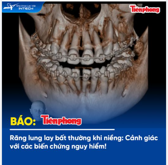 RĂNG LUNG LAY BẤT THƯỜNG KHI NIỀNG: CẢNH GIÁC VỚI CÁC BIẾN CHỨNG NGUY HIỂM!