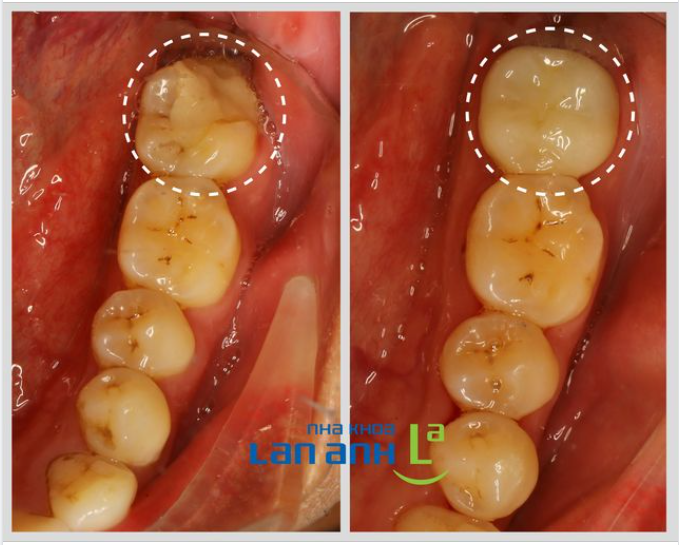 Khi răng bạn có miếng trám quá lớn, thường thì sớm muộn gì nó cũng sẽ bị bể, đặc biệt là với các răng chịu lực mạnh