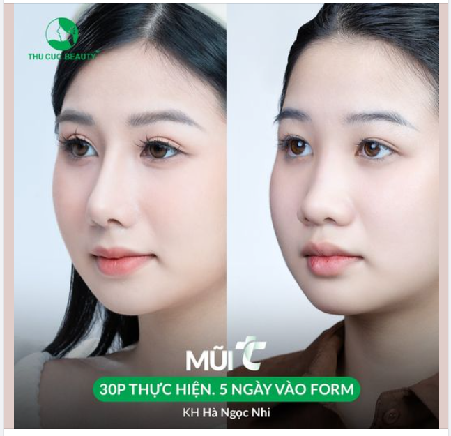 KH Hà Ngọc Nhi trước và sau 5 ngày nâng mũi