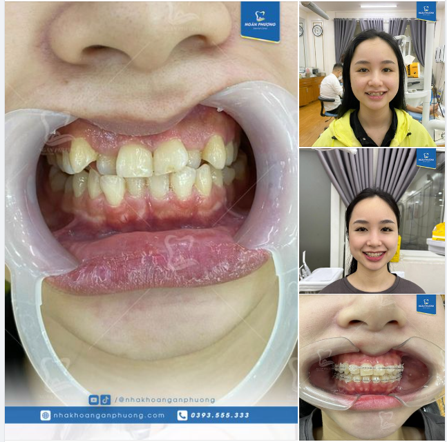 Răng khấp khểnh, cắn chéo,... có cần nhổ răng không?