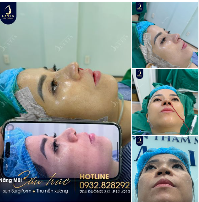 Nâng mũi đã giúp khách hàng Latin thay đổi như thế nào?