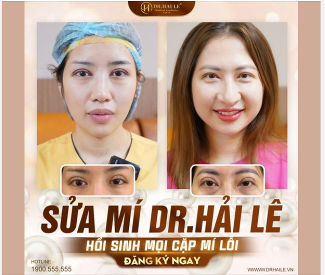 Nếu bạn đã từng nhận lại cặp mí mới cắt mà lỗi lên lỗi xuống.