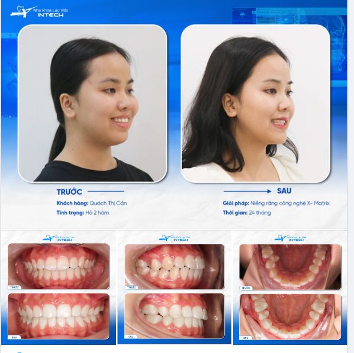 THOÁT MÁC “RĂNG HÔ” NHỜ CÔNG NGHỆ X-MATRIX, KHÁCH HÀNG SỞ HỮU GÓC NGHIÊNG “CỰC PHẨM”!