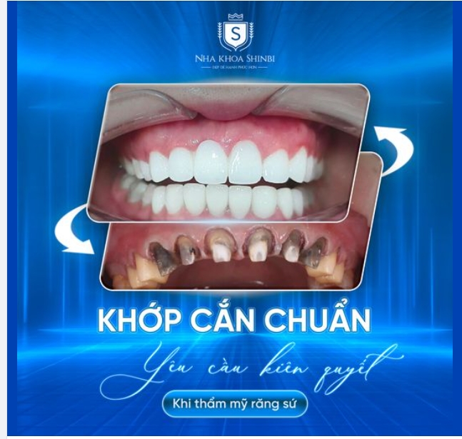 KHẲNG ĐỊNH CHẤT LƯỢNG NỤ CƯỜI VỚI RĂNG SỨ SHINBI