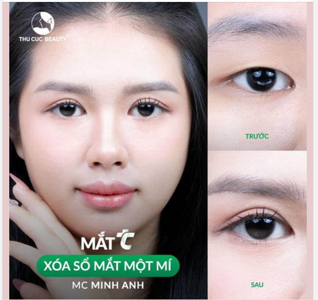 Xóa sổ mắt một mí cho MC Minh Anh