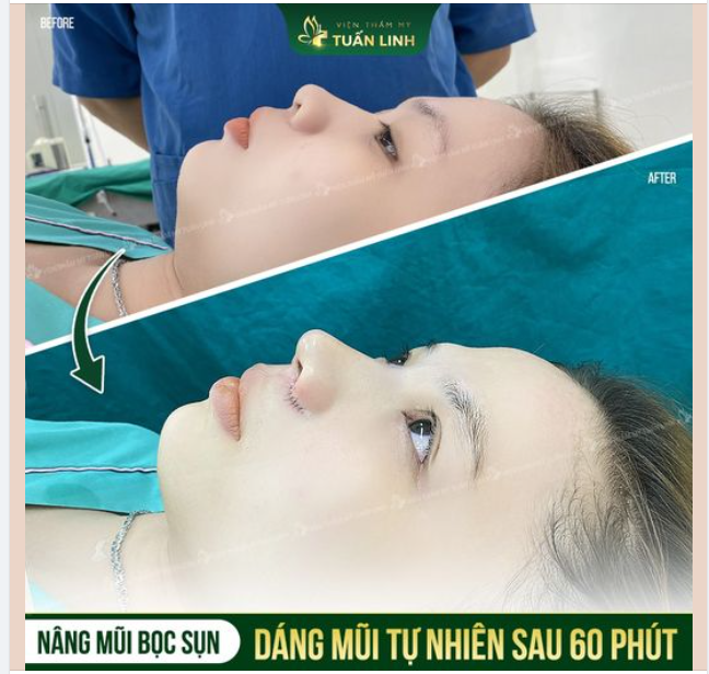Dáng mũi đẹp chuẩn tỉ lệ chỉ sau 60 phút!!