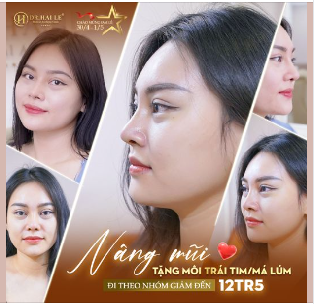 Mừng Đại Lễ - Sale tưng bừng Nâng mũi chỉ từ 10tr950