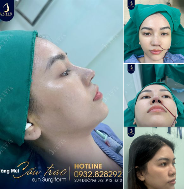 Kiến tạo dáng mũi mới cho em gái đến từ Vũng Tàu