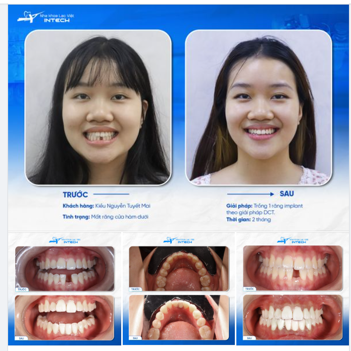 CÔ GIÁO TRẺ TÌM LẠI SỰ TỰ TIN SAU TRỒNG RĂNG IMPLANT
