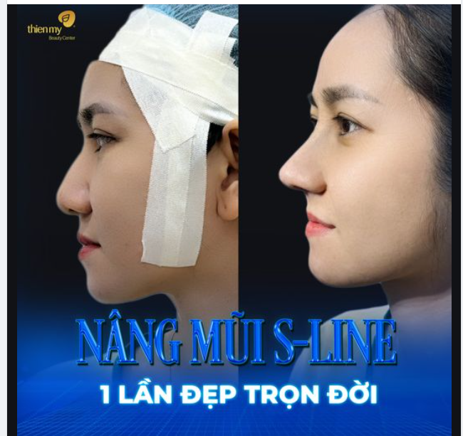 NÂNG MŨI CẤU TRÚC TẠI PKCK THIỆN MỸ