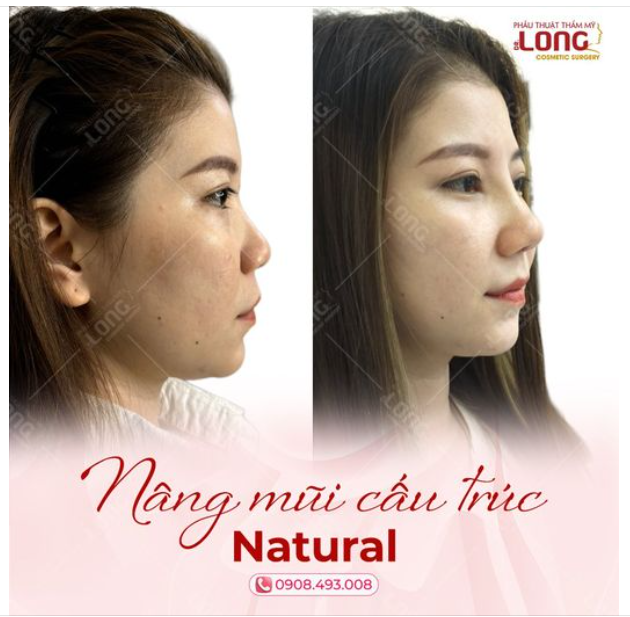 Bật mí địa chỉ nâng mũi đẹp, an toàn, uy tín tại Sài Gòn!!