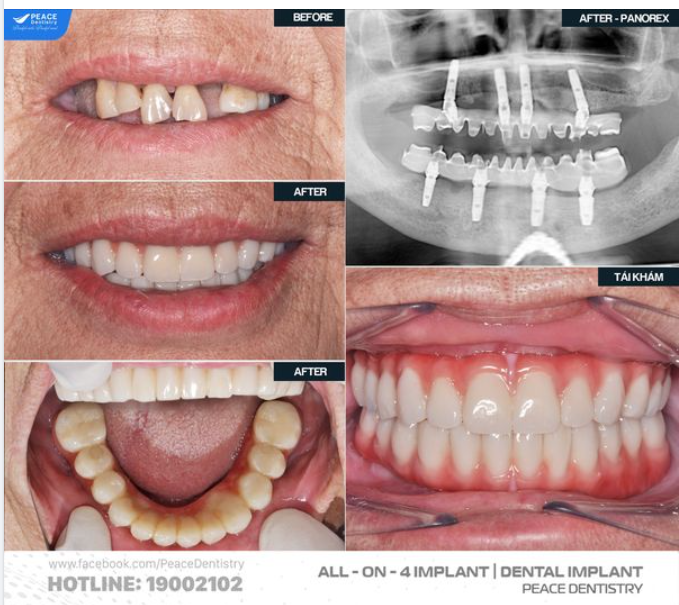 TRỒNG IMPLANT TOÀN HÀM: SAU BAO LÂU THÌ CÓ THỂ ĂN NHAI VỚI RĂNG MỚI?