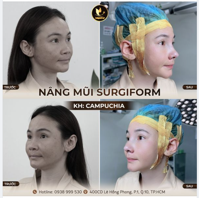 MÀN THAY ĐỔI DÁNG MŨI NGOẠN MỤC CỦA KHÁCH HÀNG CAMPUCHIA