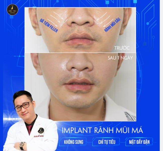 KHÔI PHỤC LẠI GƯƠNG MẶT TRÒN ĐẦY CHO CHÀNG TRAI