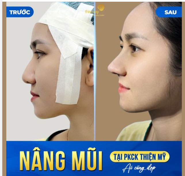 Và ai đây mà nhìn thấy quen quá! Bạn nhân viên tư vấn tại Thiện Mỹ đã thực hiện dịch vụ nâng mũi cấu trúc tại chính Phòng khám của mình.
