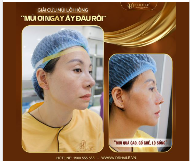 Cô cũng tiết lộ bản thân cảm thấy hoang mang, lo lắng và hết sự tự ti mỗi khi nhìn bản thân trong gương. Cô thậm chí không còn dám tụ tập bạn bè vì chiếc mũi lỗi hỏng của mình.