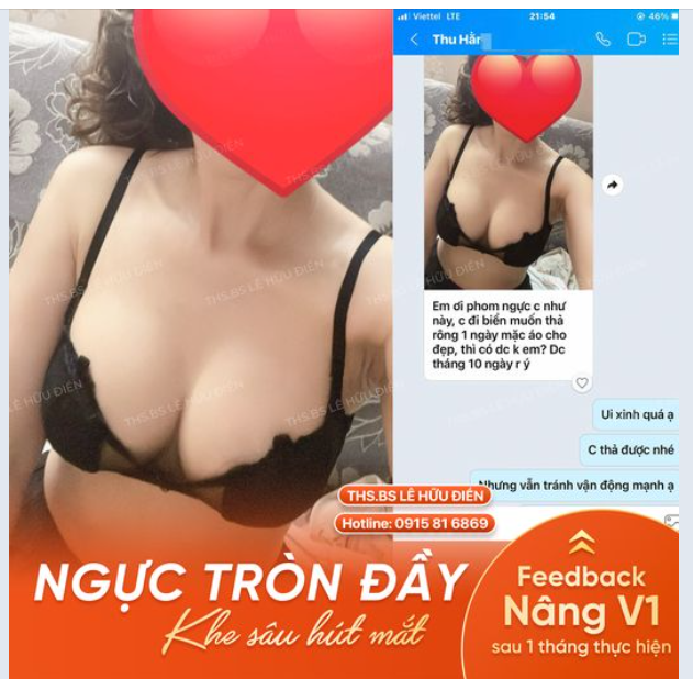 Nâng ngực sau 1 tháng thực hiện.