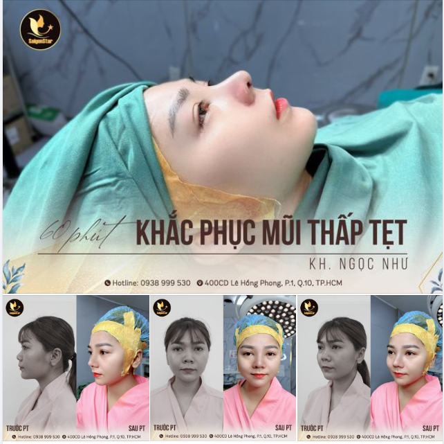 POST NÀY CHỦ YẾU KHOE MŨI ĐẸP NHÀ BÁC SĨ HOẠT SAU 60 PHÚT