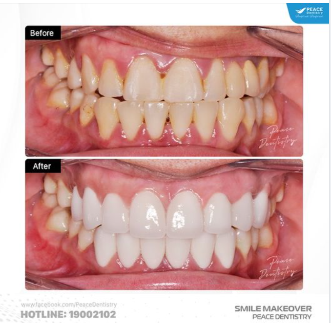 VENEER VÀ NHỮNG GÌ BẠN NÊN BIẾT