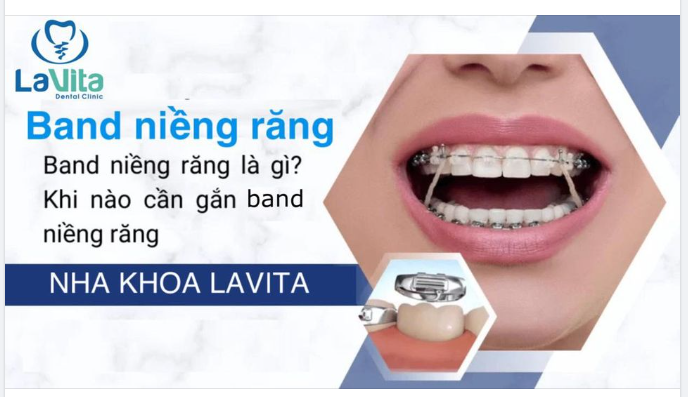 BAND NIỀNG RĂNG LÀ GÌ? KHI NÀO CẦN GẮN BAND NIỀNG RĂNG?