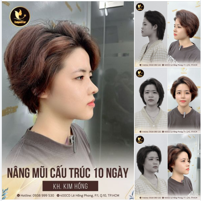 NÂNG MŨI CẤU TRÚC SAU 10 NGÀY MŨI LÊN CHUẨN FORM – GÓC NGHIÊNG SIÊU NÉT