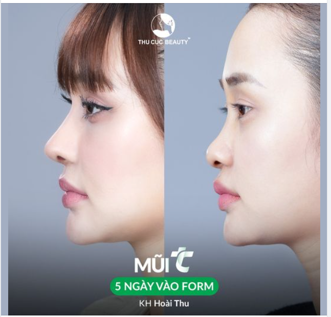 Chỉ 30P Có ngay dáng mũi cao sang, chuẩn sao Hàn