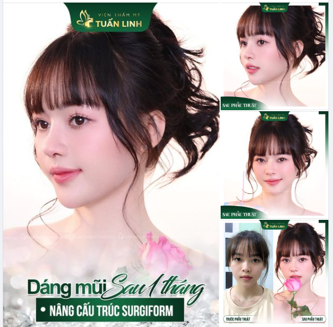 Kết quả mĩ mãn sau 1 tháng nâng mũi cấu trúc Surgiform!!