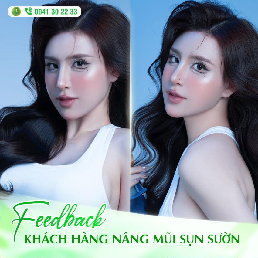 FEEDBACK CỦA CÔ NÀNG N.LY SAU NÂNG MŨI