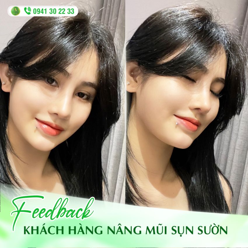 MŨI ĐẸP, BỀN NHỜ CÔNG NGHỆ SỤN SƯỜN FASCIA