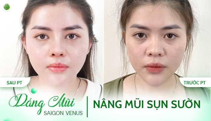 NHAN SẮC THĂNG HẠNG - MŨI ĐẸP BỀN, LÂU