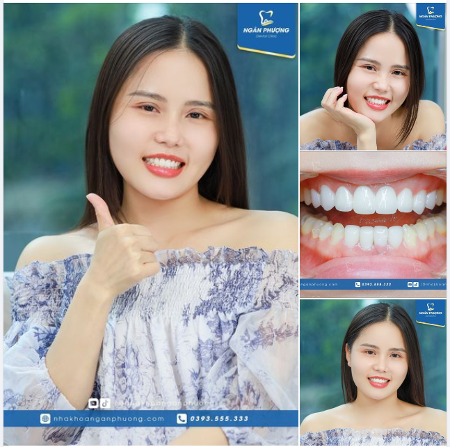 Răng sứ có thể sử dụng được bao lâu?