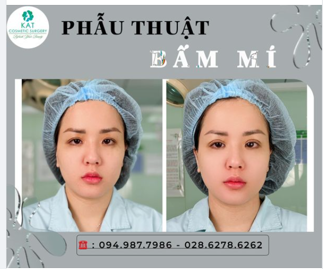 BẤM MÍ : Sự lựa chọn hoàn hảo cho các cô nàng có ít da dư và mỡ thừa, những cô nàng mắt một mí, nhiều mí lót nhưng vẫn muốn sở hữu đôi mắt hai mí to tròn.