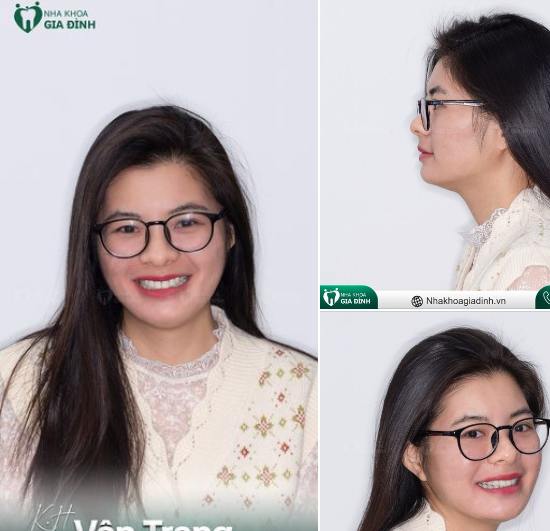 2 NĂM NIỀNG RĂNG ĐỔI LẤY 1 NỤ CƯỜI ĐẸP MỸ MÃN
