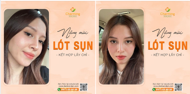 Sau khi nâng mũi chỉ nàng khách đã đến Charming để nâng mũi lót sụn kết hợp mổ hở lấy chỉ, từ đó giúp nàng có được chiếc mũi cao, cân đối nhưng lại giữ được lâu hơn và hạn chế các biến chứng có thể xảy ra khi thực hiện nâng mũi chỉ ^^