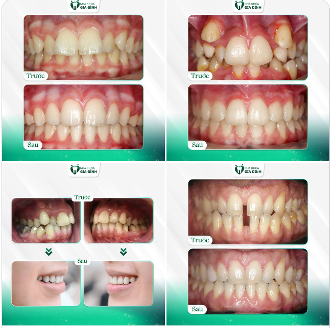HÃY ĐỂ NIỀNG RĂNG MANG ĐẾN CHO BẠN SỰ TỰ TIN VÀ HẠNH PHÚC