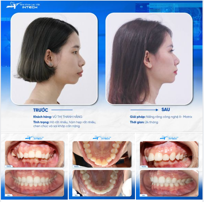 HÔ RĂNG THAY ĐỔI GÓC NGHIÊNG NGOẠN MỤC SAU NIỀNG RĂNG