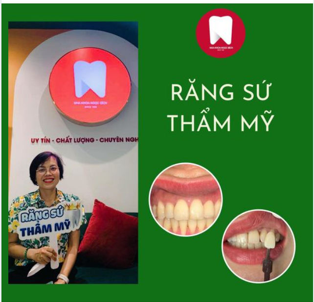 RĂNG SỨ ĐẸP TỰ NHIÊN NHƯ RĂNG THẬT - TỚI NGAY NHA KHOA NGỌC BÍCH
