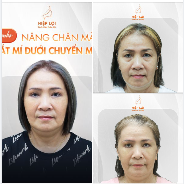 Combo NÂNG CHÂN MÀY - CẮT MÍ DƯỚI CHUYỂN MỠ